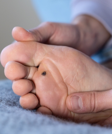 micosis dermatológica