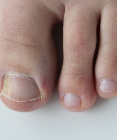 micosis ungeal